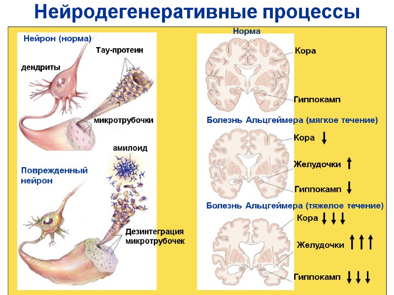 Нейродегенеративные процессы Нейрон (норма) дендриты микротрубочки Тау-протеин Дезинтеграция микротрубочек амилоид Поврежденный нейрон Норма Кора